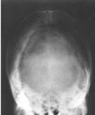 Posicionamiento Axial Cráneo